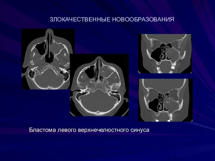 ЗЛОКАЧЕСТВЕННЫЕ НОВООБРАЗОВАНИЯ Бластома левого верхнечелюстного синуса