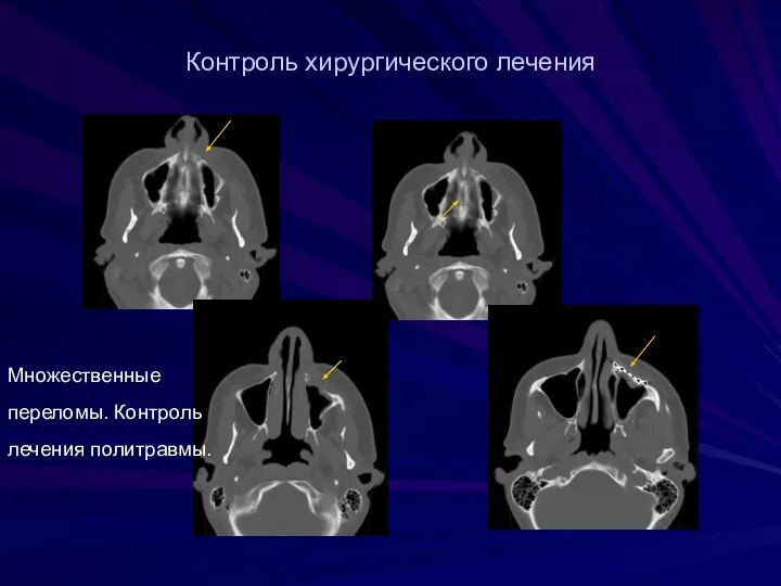 Контроль хирургического лечения Множественные переломы. Контроль лечения политравмы.