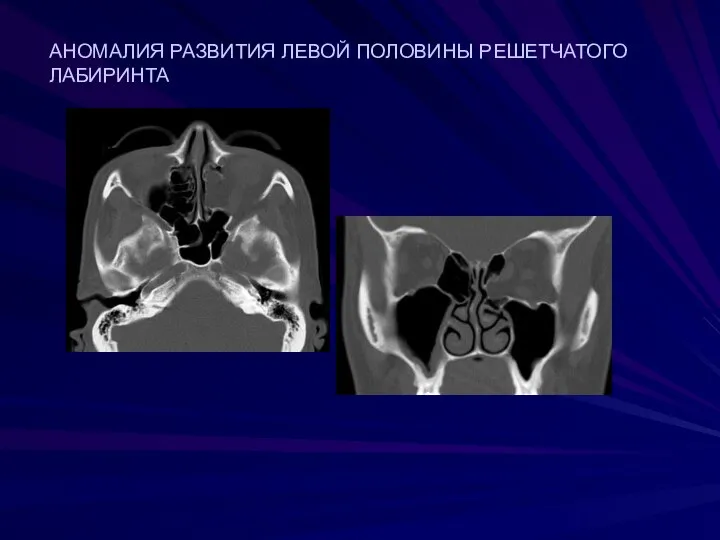 АНОМАЛИЯ РАЗВИТИЯ ЛЕВОЙ ПОЛОВИНЫ РЕШЕТЧАТОГО ЛАБИРИНТА