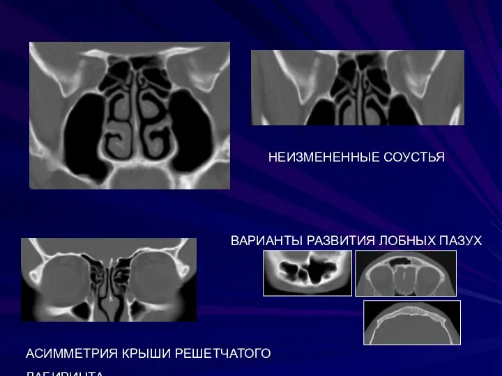 НЕИЗМЕНЕННЫЕ СОУСТЬЯ АСИММЕТРИЯ КРЫШИ РЕШЕТЧАТОГО ЛАБИРИНТА, ВАРИАНТЫ РАЗВИТИЯ ЛОБНЫХ ПАЗУХ