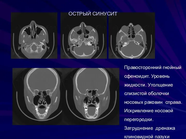 Правосторонний гнойный сфеноидит. Уровень жидкости. Утолщение слизистой оболочки носовых раковин справа.