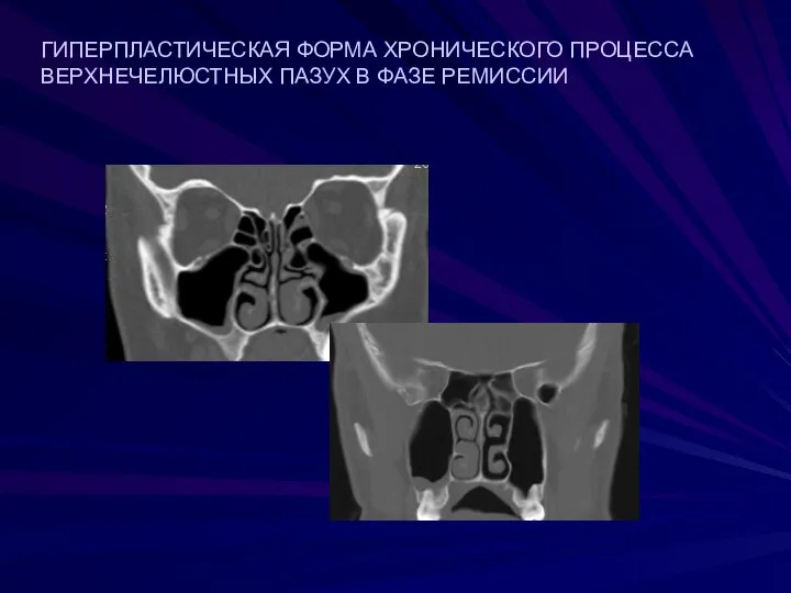 ГИПЕРПЛАСТИЧЕСКАЯ ФОРМА ХРОНИЧЕСКОГО ПРОЦЕССА ВЕРХНЕЧЕЛЮСТНЫХ ПАЗУХ В ФАЗЕ РЕМИССИИ