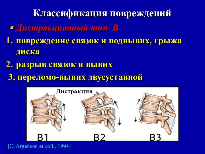 Классификация повреждений Дистракционный тип В повреждение связок и подвывих, грыжа диска