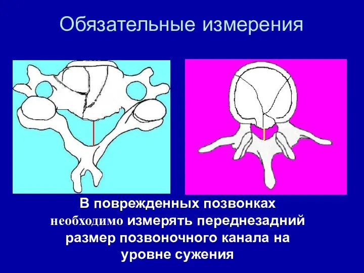 Обязательные измерения В поврежденных позвонках необходимо измерять переднезадний размер позвоночного канала на уровне сужения