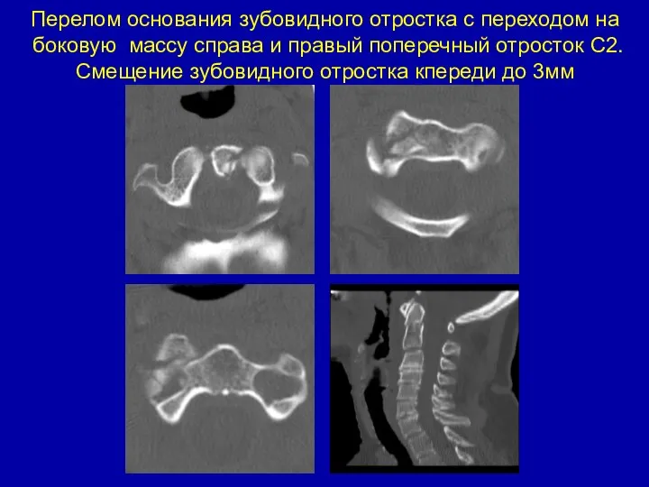 Перелом основания зубовидного отростка с переходом на боковую массу справа и