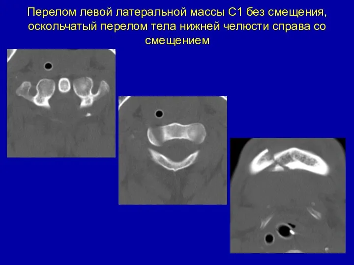 Перелом левой латеральной массы С1 без смещения, оскольчатый перелом тела нижней челюсти справа со смещением