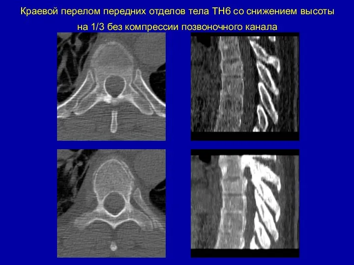 Краевой перелом передних отделов тела ТН6 со снижением высоты на 1/3 без компрессии позвоночного канала