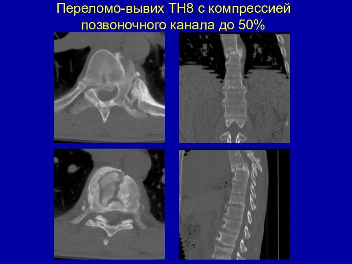 Переломо-вывих ТН8 с компрессией позвоночного канала до 50%