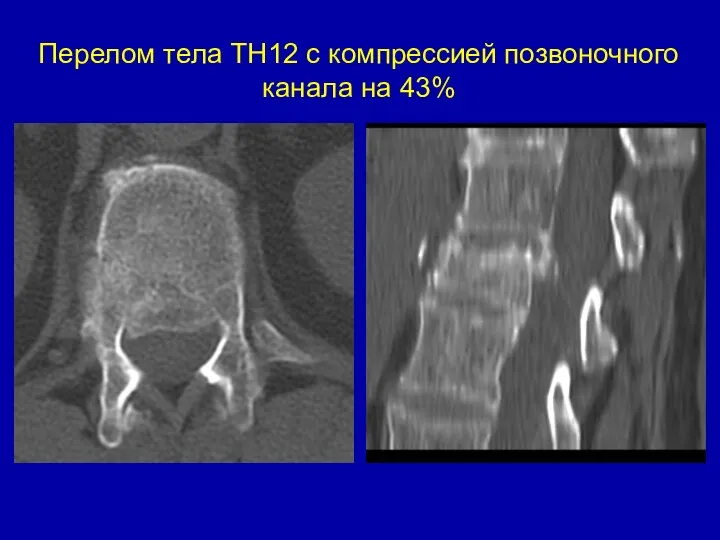 Перелом тела ТН12 с компрессией позвоночного канала на 43%