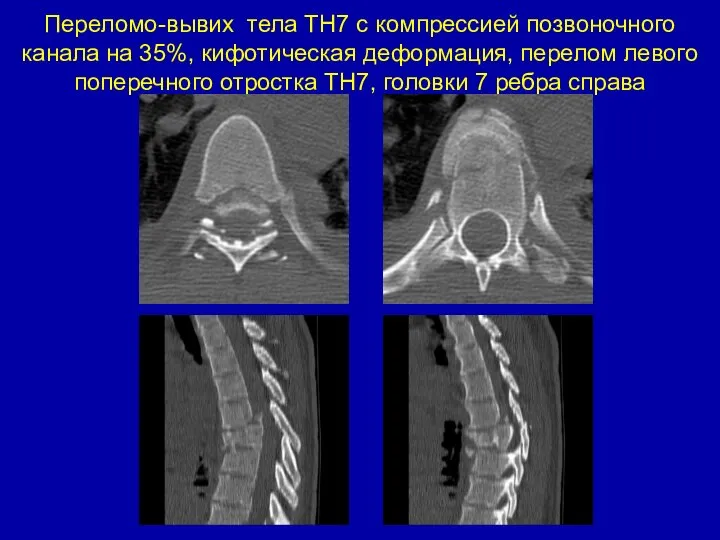 Переломо-вывих тела ТН7 с компрессией позвоночного канала на 35%, кифотическая деформация,