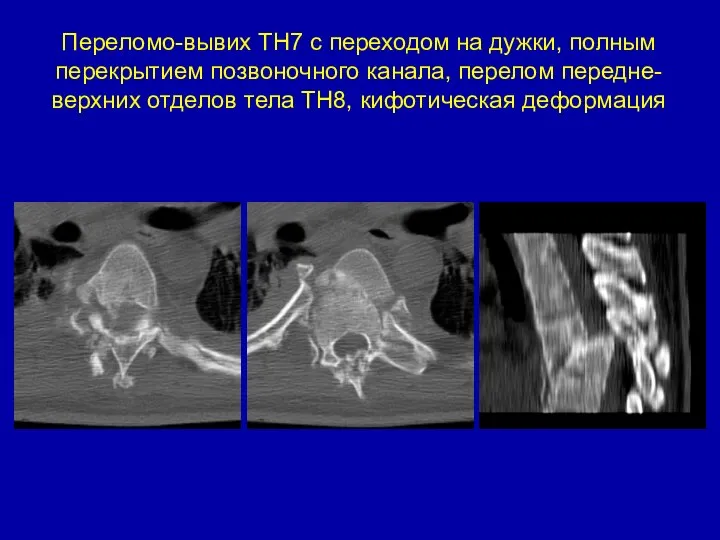 Переломо-вывих ТН7 с переходом на дужки, полным перекрытием позвоночного канала, перелом