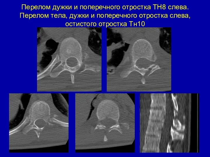 Перелом дужки и поперечного отростка ТН8 слева. Перелом тела, дужки и
