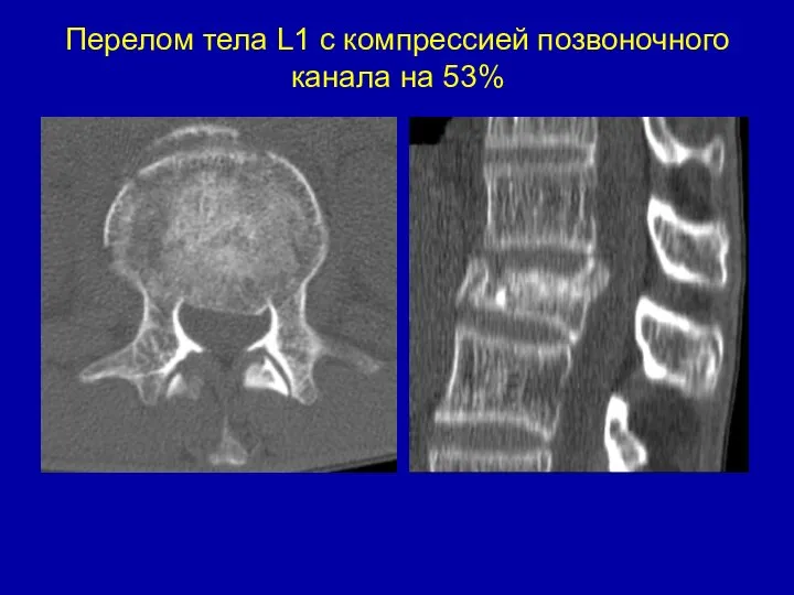 Перелом тела L1 c компрессией позвоночного канала на 53%