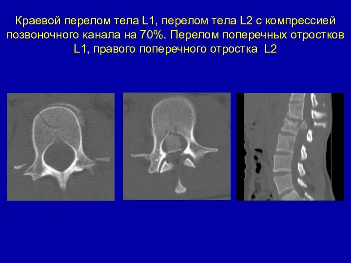 Краевой перелом тела L1, перелом тела L2 с компрессией позвоночного канала