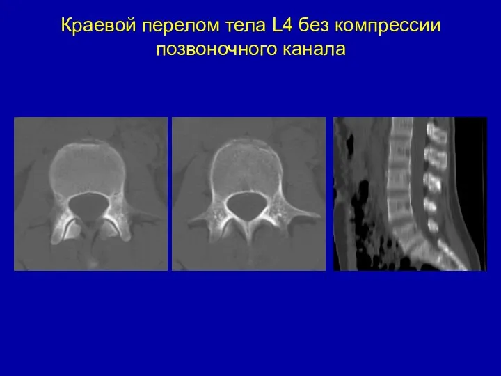 Краевой перелом тела L4 без компрессии позвоночного канала