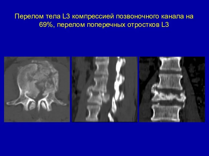 Перелом тела L3 компрессией позвоночного канала на 69%, перелом поперечных отростков L3