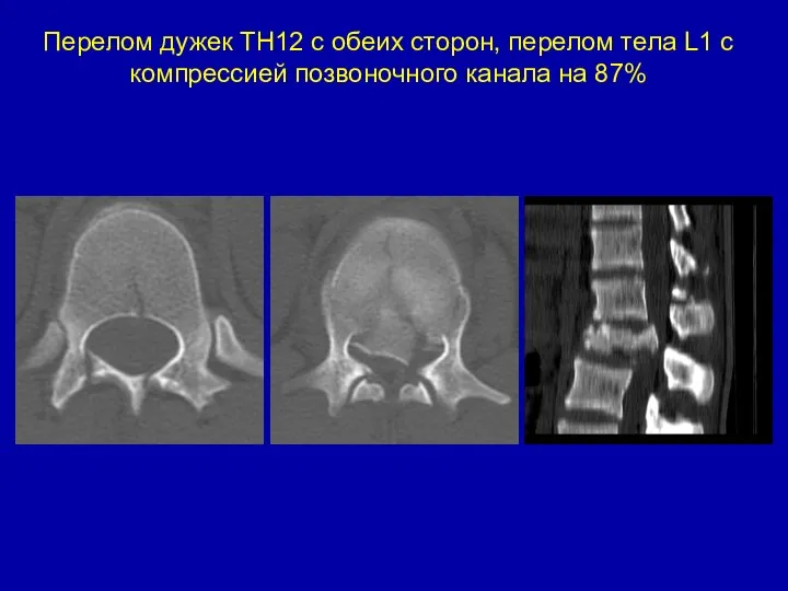 Перелом дужек ТН12 с обеих сторон, перелом тела L1 c компрессией позвоночного канала на 87%