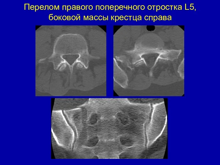 Перелом правого поперечного отростка L5, боковой массы крестца справа