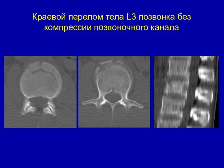 Краевой перелом тела L3 позвонка без компрессии позвоночного канала