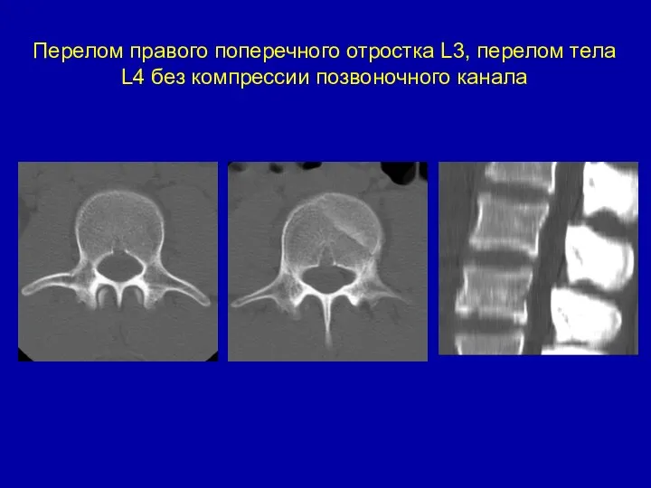 Перелом правого поперечного отростка L3, перелом тела L4 без компрессии позвоночного канала