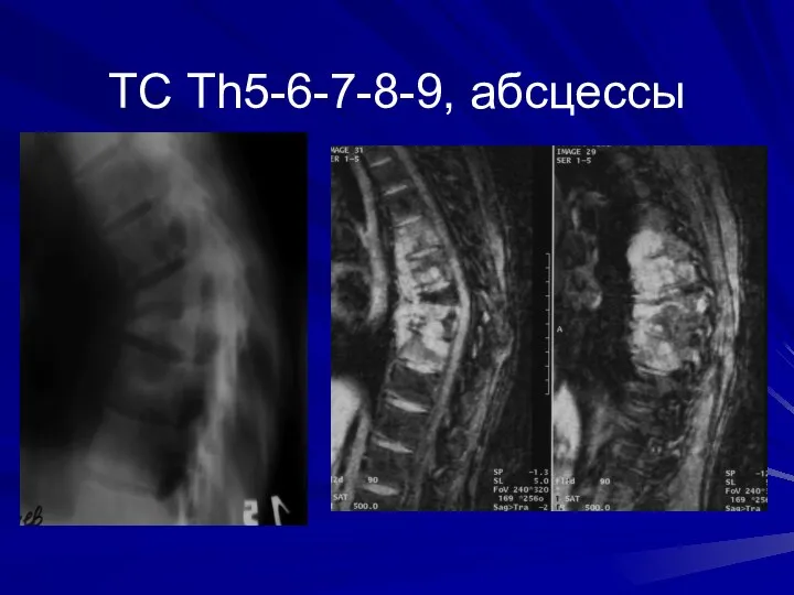 ТС Th5-6-7-8-9, абсцессы