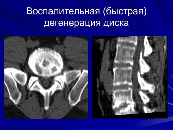 Воспалительная (быстрая) дегенерация диска