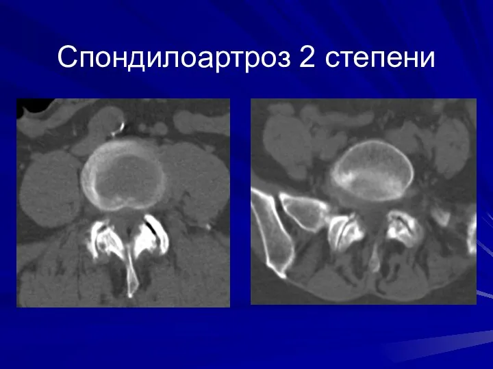 Спондилоартроз 2 степени