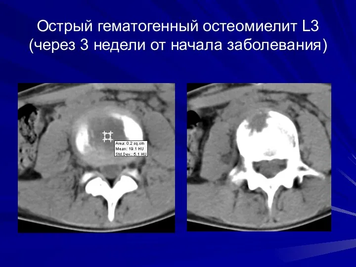 Острый гематогенный остеомиелит L3 (через 3 недели от начала заболевания)