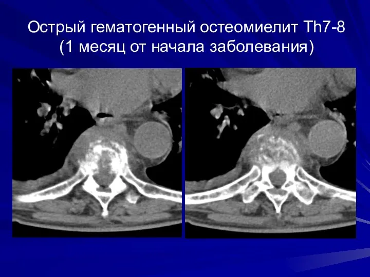 Острый гематогенный остеомиелит Th7-8 (1 месяц от начала заболевания)