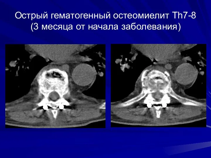 Острый гематогенный остеомиелит Th7-8 (3 месяца от начала заболевания)