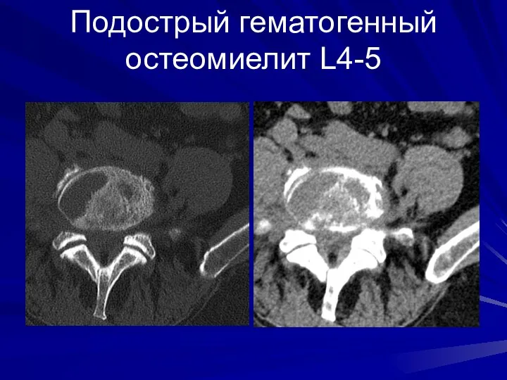 Подострый гематогенный остеомиелит L4-5