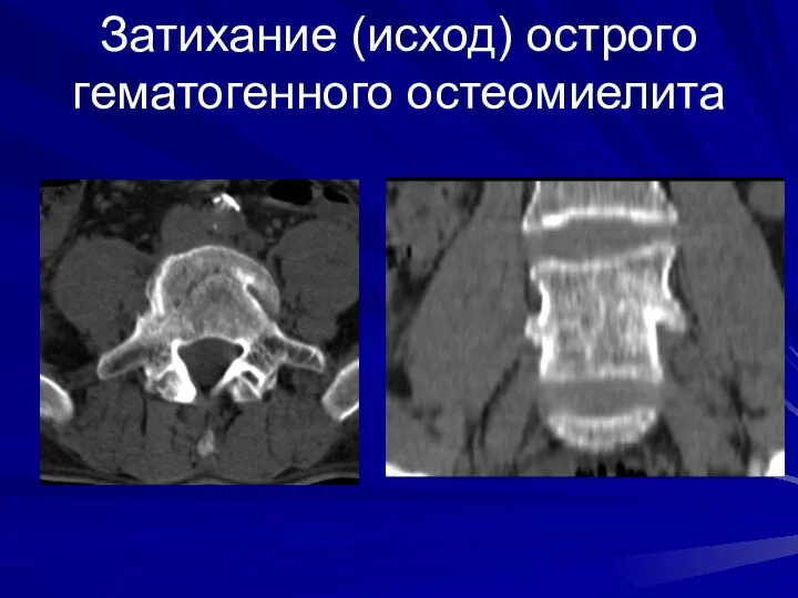 Затихание (исход) острого гематогенного остеомиелита