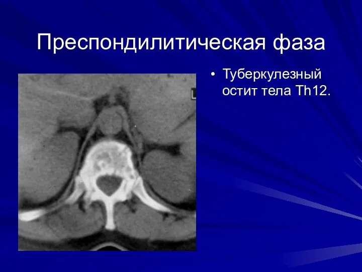 Преспондилитическая фаза Туберкулезный остит тела Th12.