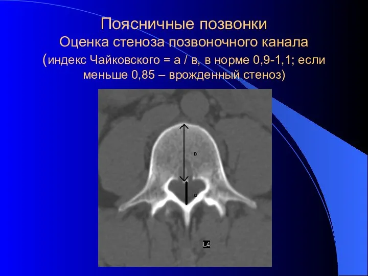 Поясничные позвонки Оценка стеноза позвоночного канала (индекс Чайковского = а /