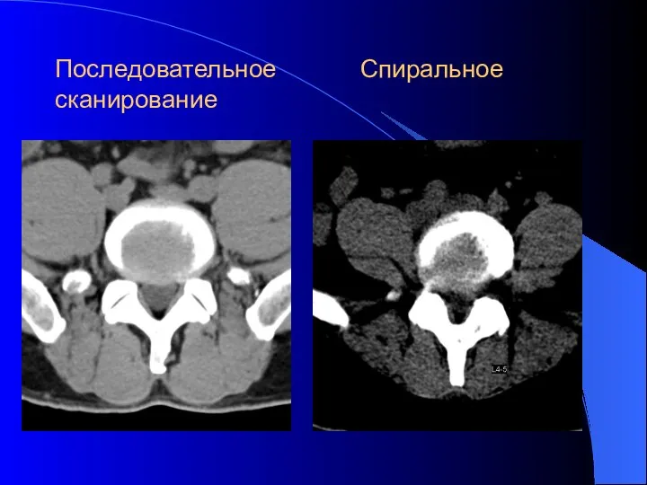 Последовательное Спиральное сканирование