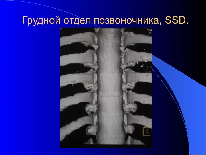 Грудной отдел позвоночника, SSD.