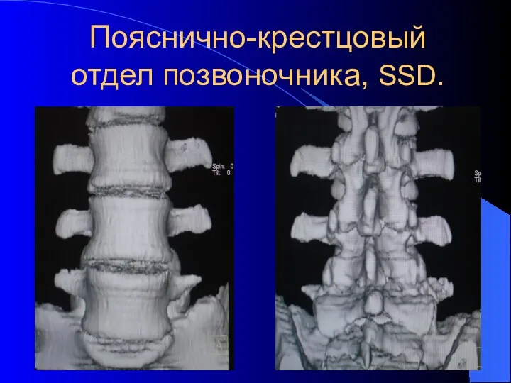 Пояснично-крестцовый отдел позвоночника, SSD.