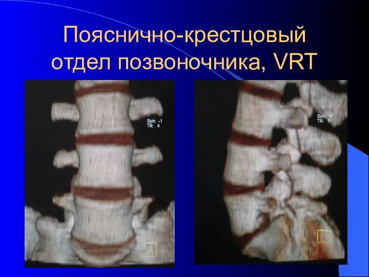 Пояснично-крестцовый отдел позвоночника, VRT