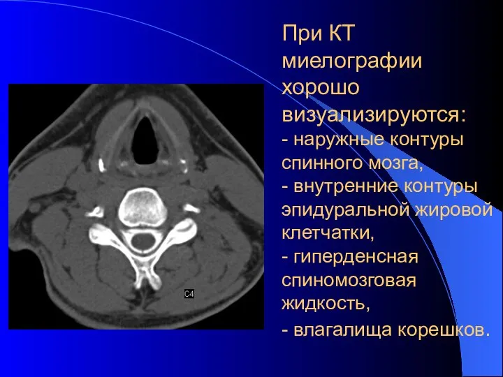 При КТ миелографии хорошо визуализируются: - наружные контуры спинного мозга, -