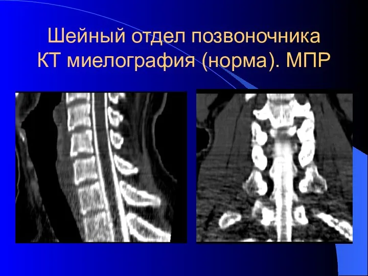 Шейный отдел позвоночника КТ миелография (норма). МПР