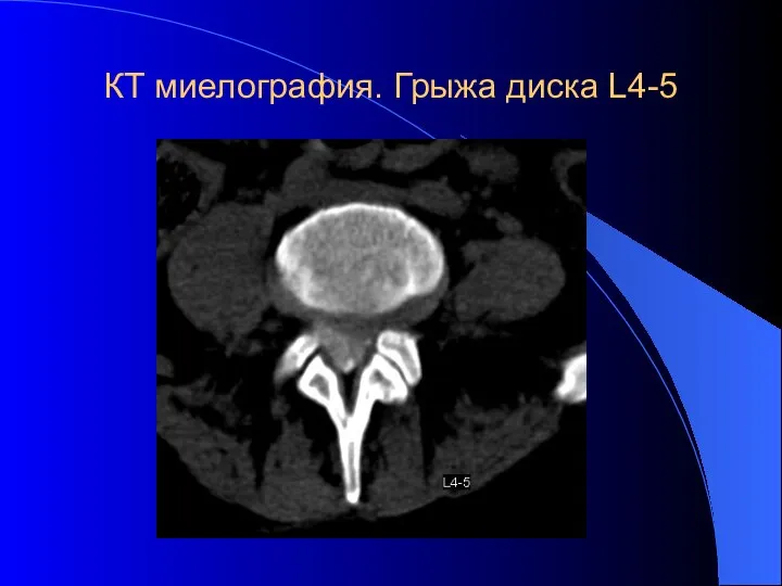 КТ миелография. Грыжа диска L4-5