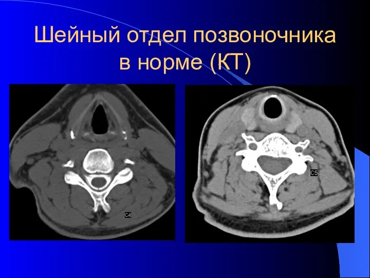 Шейный отдел позвоночника в норме (КТ)