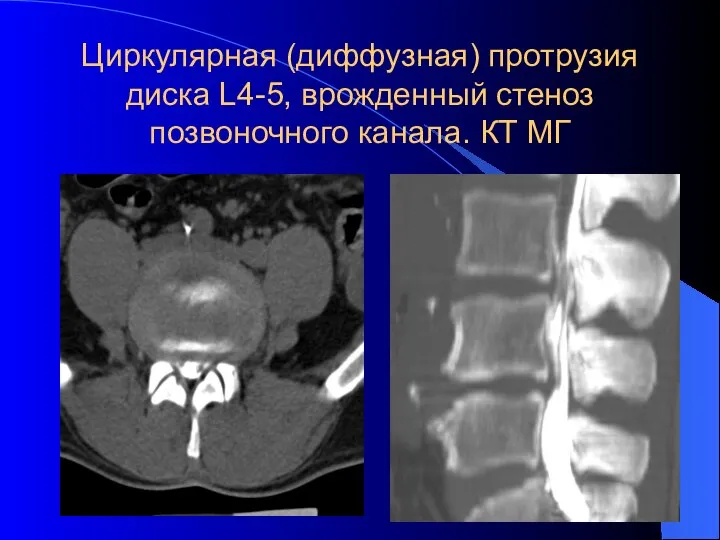 Циркулярная (диффузная) протрузия диска L4-5, врожденный стеноз позвоночного канала. КТ МГ