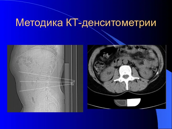 Методика КТ-денситометрии