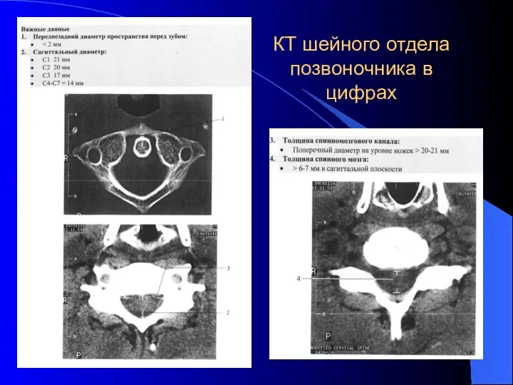 КТ шейного отдела позвоночника в цифрах