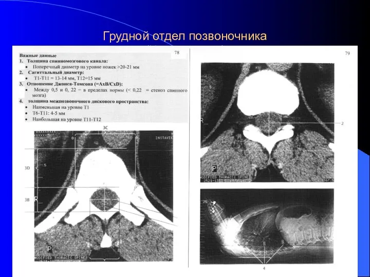 Грудной отдел позвоночника (КТ в цифрах)