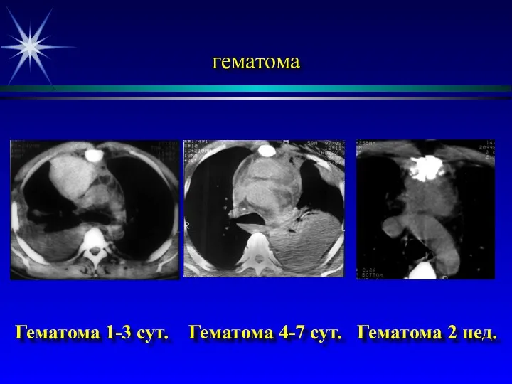 Дифференциальная диагностика острого медиастинита и гематомы средостения гематома Гематома 1-3 сут.