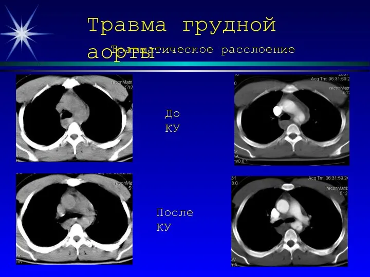 Травма грудной аорты До КУ После КУ Травматическое расслоение