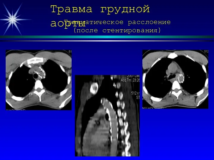 Травма грудной аорты Травматическое расслоение (после стентирования)