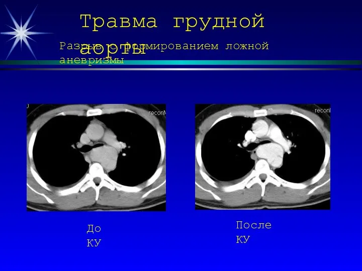 Травма грудной аорты Разрыв с формированием ложной аневризмы До КУ После КУ